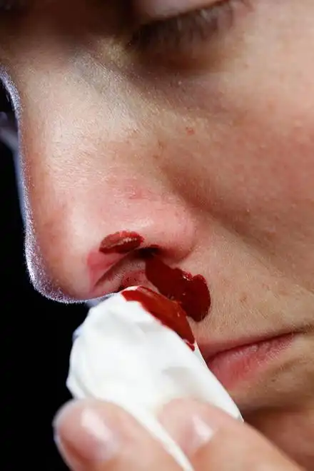 鼻子出血怎么办?