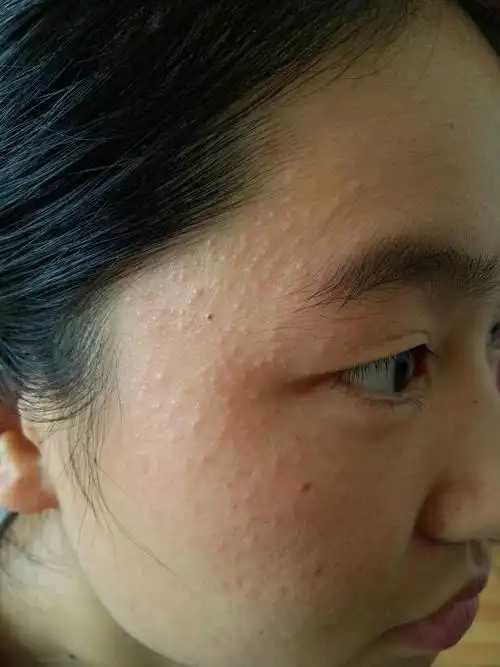 右边太阳穴长出许多像疹子一样的细小颗粒,而且慢慢遍及至脸上,请问这