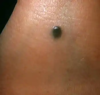 这颗痣比大多数痣凸起得更高.