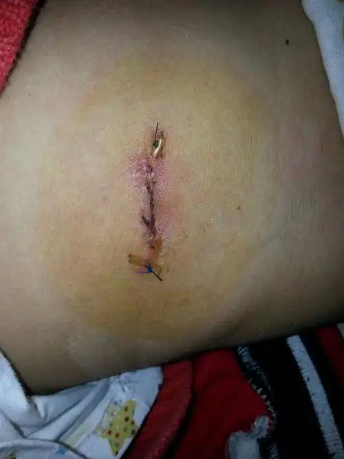 医生你好,我家小孩刚做了阑尾炎手术7天,今天发现伤口有点发炎流水,能