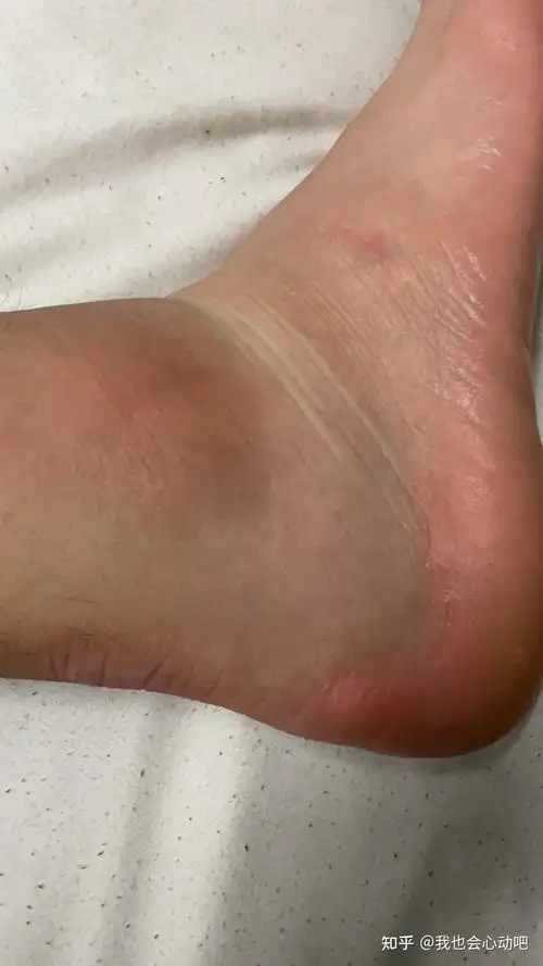 脚崴了肿了如果不及时处理会怎样