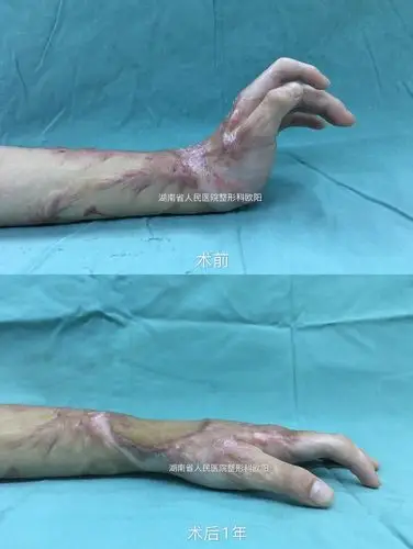 手腕部挛缩疤痕松解植皮