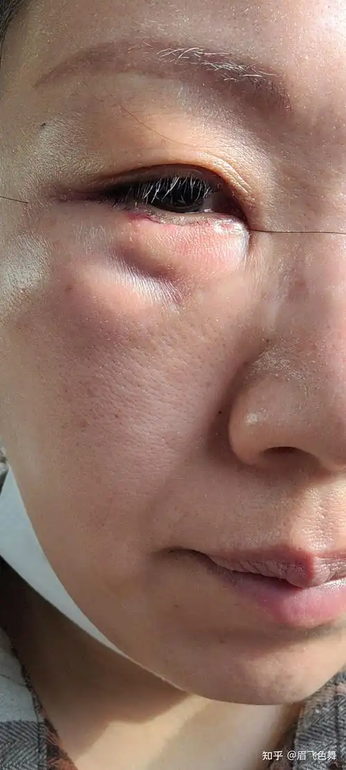 外切眼袋手术第二天左边眼睛有个坑不知道是不是正常的好担心