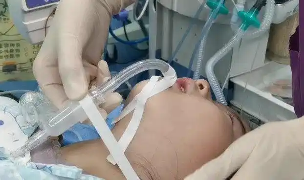 接上呼吸机.jpg