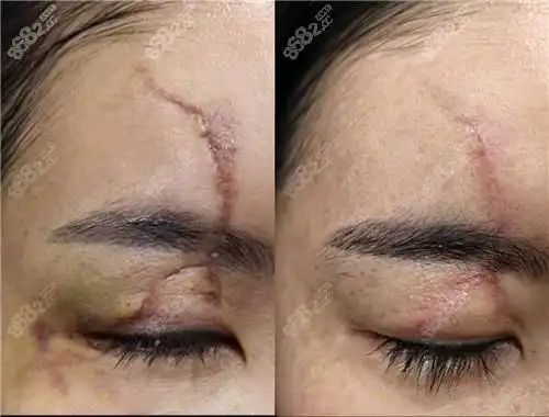 重庆艺星医疗美容医院激光祛疤对比