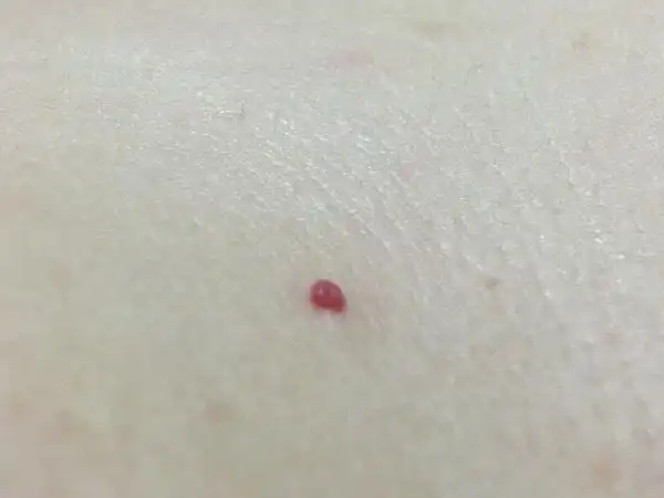 身上有图一这种红色凸起的小血点,有好几个,又一次把身上有个地方的