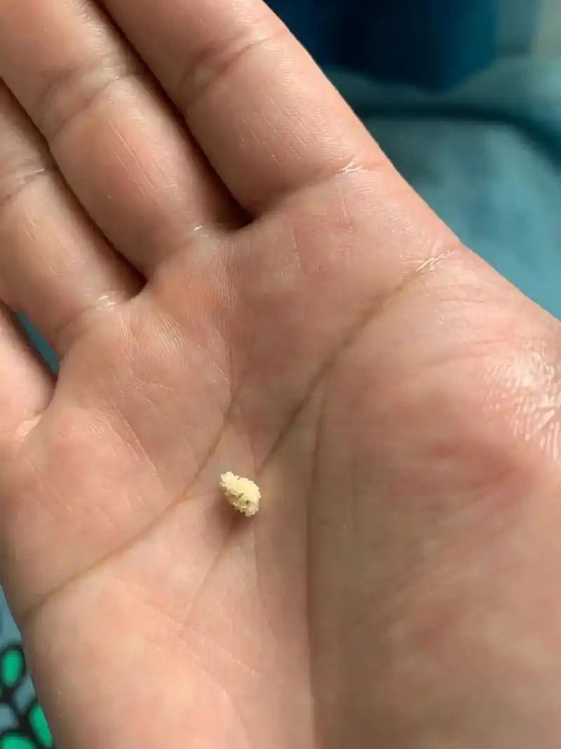 折磨我一个多月的肾结石在今天早上终于尿了出来,是一个不规则淡黄色
