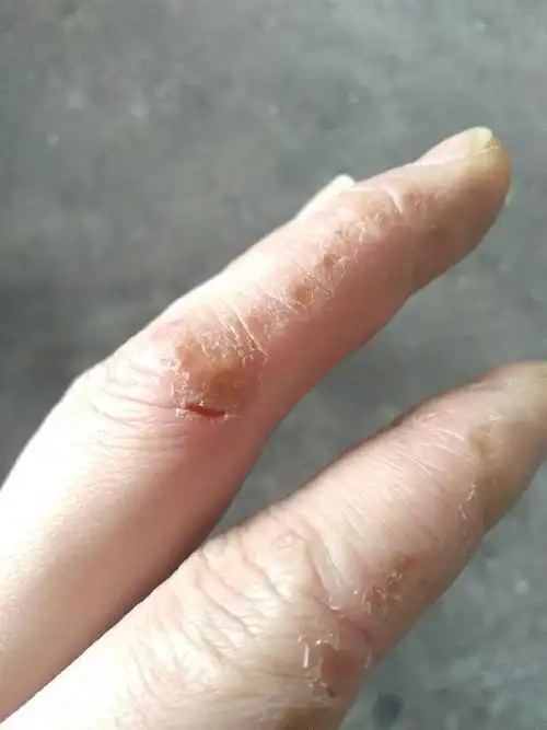 手开裂 每年冬天会严重一些 请问怎么办?