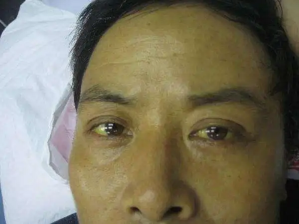 肝癌晚期确诊前,身体会多次发出求救讯号!很多癌患都不当回事!