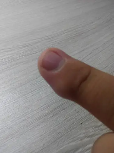 手指头肿了,有医生说关节囊肿,自己查资料说是手指腱鞘炎.