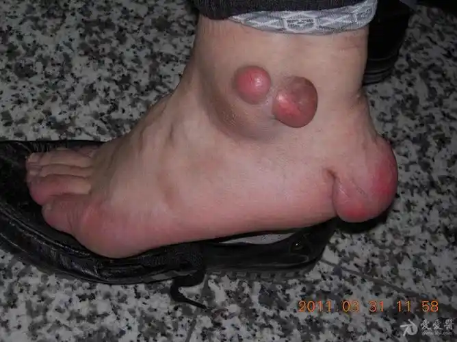 门诊遇到的病人——结节性黄瘤