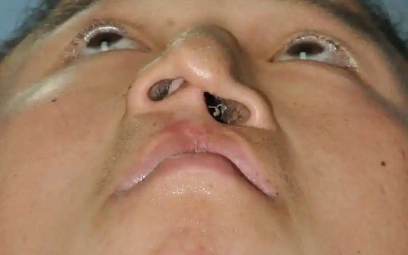 唇裂二期鼻唇畸形手术修复 - 好大夫在线