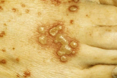 带状疱疹的饮食禁忌有哪些带状疱疹患者有什么要注意的多图