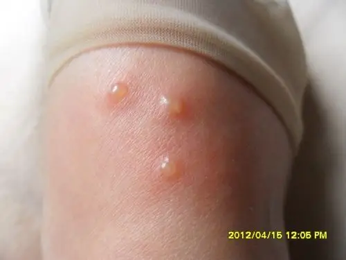 脚上红点有水泡而且很痒是什么问题?我查了下类似湿疹但又不确定