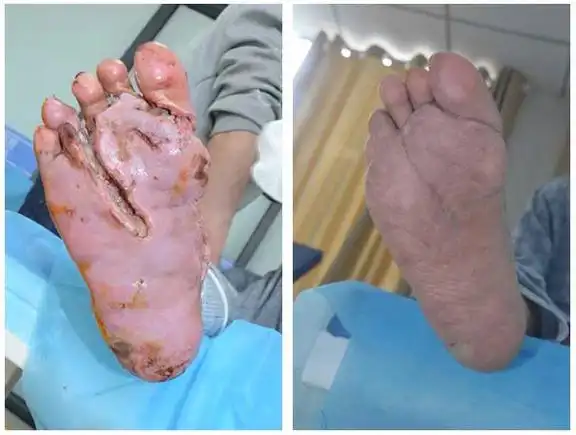 糖尿病脚烂最好偏方,缓解烂脚的有效方法-花瓣养生-花瓣饮食养生-花瓣