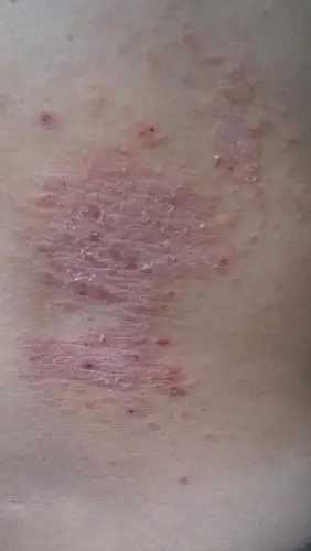 身上长了这个东西怎么办