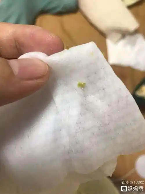 回答孩子这种情况不排除是上火或患结膜炎造成的眼屎建议多喝水,如果