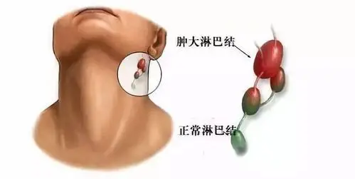 急性淋巴结炎局部先有淋巴结肿大,疼痛和触痛,可与周围软组织分辨