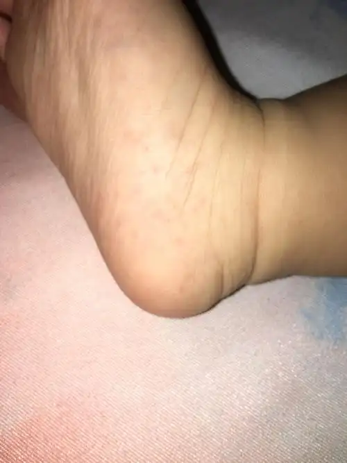 十月大宝宝脚底皮下有红米米?是天气热的痱子,还是真菌感染啊?