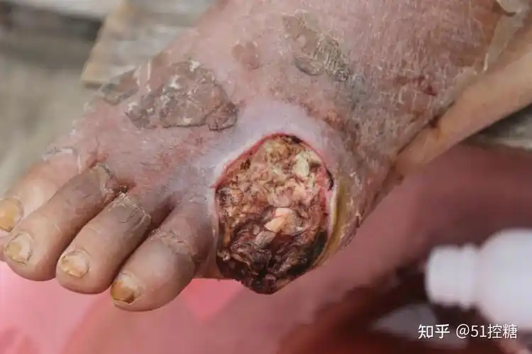 糖友如何预防糖尿病足