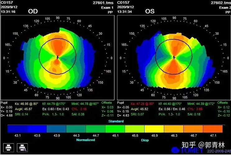 原始角膜地形图如下:综合以上信息,给与患者选择角膜塑形镜验配:从