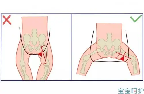 注意宝宝双腿的这些表现,可能是得了这种骨骼病_髋关节