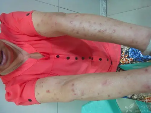 皮疹在四肢和头面部,痒.要好的治疗方法吗