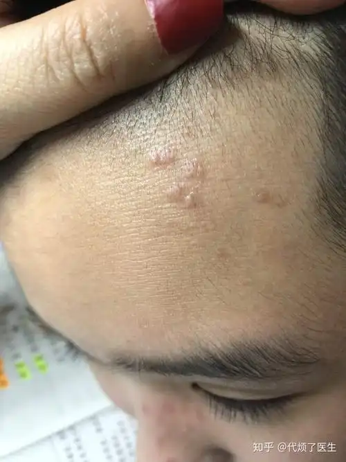 儿童额头的寻常疣,注意鼻子也有.主要是孩子抓挠导致部位传染