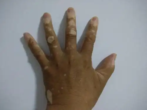 早期白癜风诊断可以通过这些方法_白斑