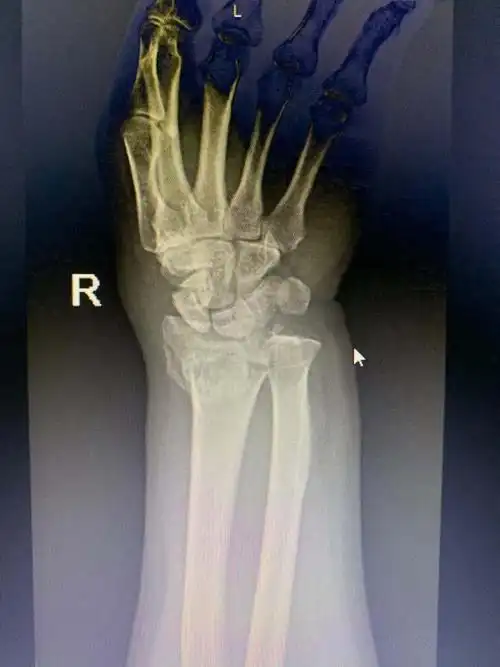 右侧桡骨远端骨折