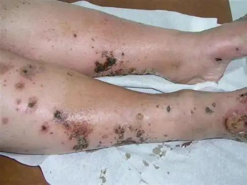 血管炎前期综合征