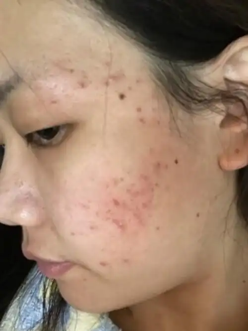 痘坑真的非常影响上妆了,每次我画完妆那个脸坑坑洼洼_圈子-新氧美容