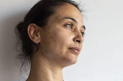 肝火旺或肝气郁结便易形成气血不通,影响面部的血液循环,皮肤自然暗淡