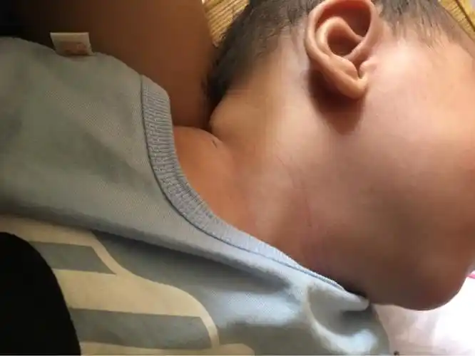 急急急!宝宝脖子上鼓了一个包