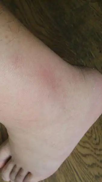 问:前一阵子运动过量,脚踝肿了,脚踝骨头盖侧面肿起来,摸下去里面有个