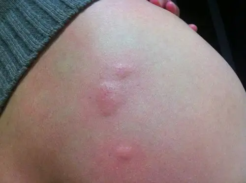 虫咬性皮炎图片 (109)_有来医生
