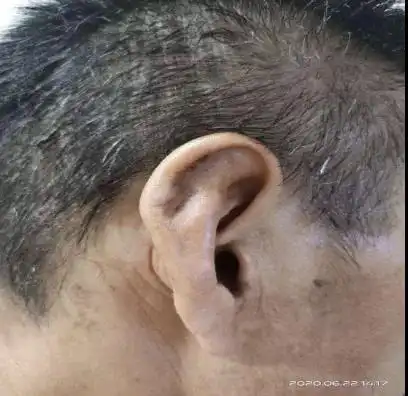 江主任提醒大家:耳廓假性囊肿要积极预防,此病男性多于女性达数十倍