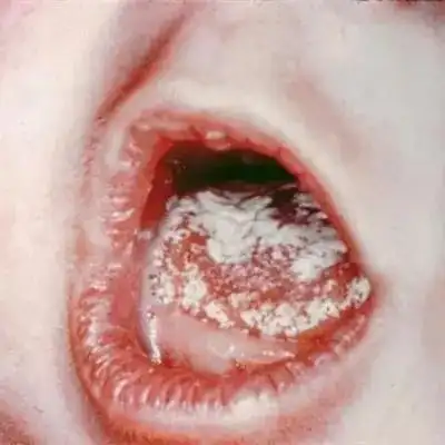 白色念珠菌感染