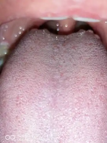 舌根部有很多红色突出肉疙瘩,舌头有时有点麻,同时喉咙吞口水时感觉有