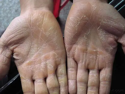 三例手掌肥厚角化病人