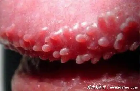 男女尖湿锐尤典型早期图片,皆呈现菜花/鸡冠状疣体(胆小勿扰)_七七号