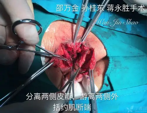 产伤性肛门失禁(会阴撕裂伤四度)前修补手术(anterior repair)