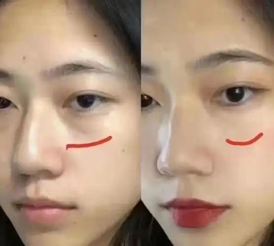 下图是填充一周以后的效果对比