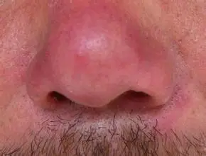 鼻端弥漫性潮红