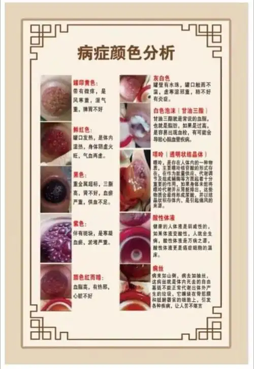 较多小水泡时,预示由水湿所致,会有理想的疗效,需要连续的多次拔罐