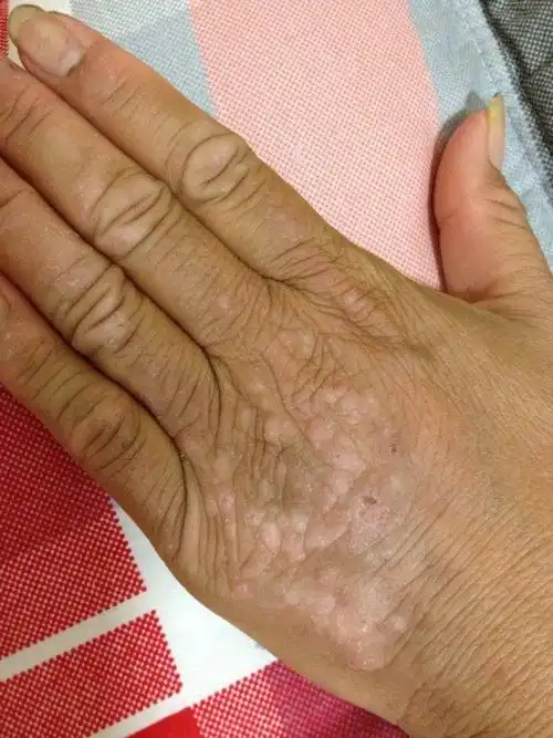 手上好痒,大家帮忙看看是什么情况