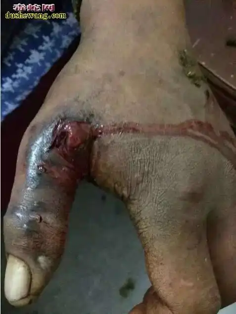 五步蛇咬了后的图片恐怖五步蛇咬伤吓死宝宝了