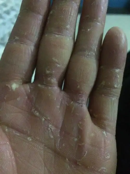 手脱皮严重,请问有什么药可以治好,谢谢!