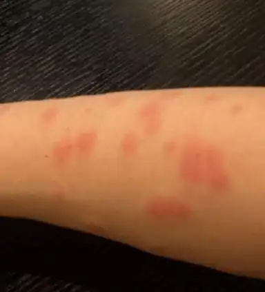 多伦多华人崩溃送礼求人才租到的公寓竟然满是床虱