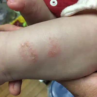 五个月的宝宝腿上长了块像癣一样的,皮肤发硬,很长时间也不好